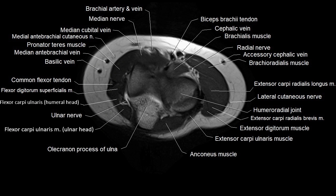 MRI 3T forearm axial cross sectional anatomy image 6.webp